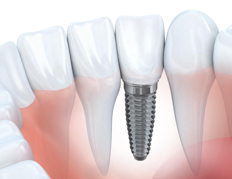 dental-implants