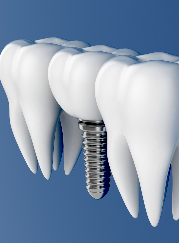 implants