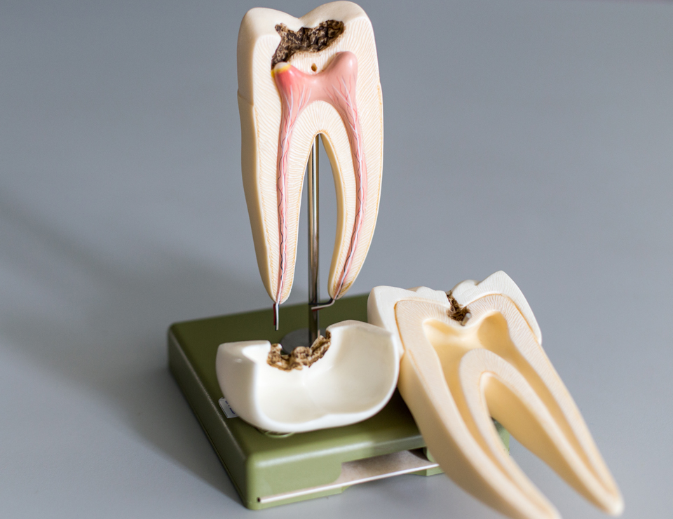 root-canel-treatment