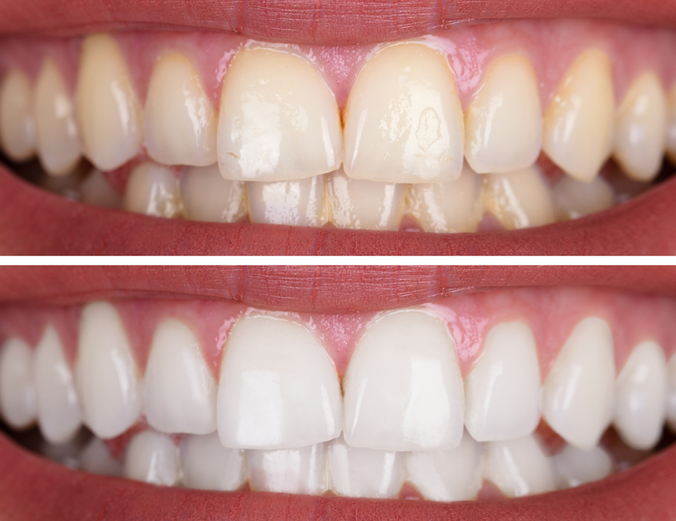 tooth-whitening
